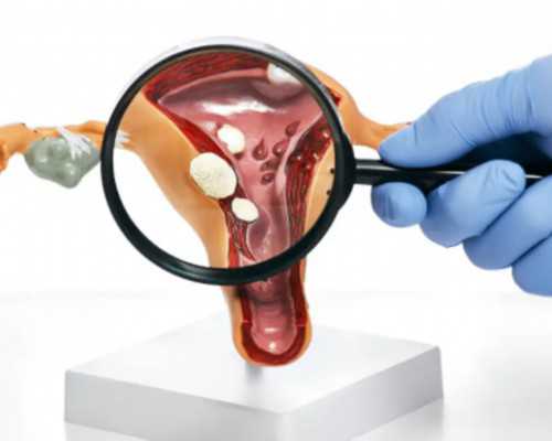 国内供卵大概要多少钱,患有腺肌症试管婴儿之路会很艰难吗？